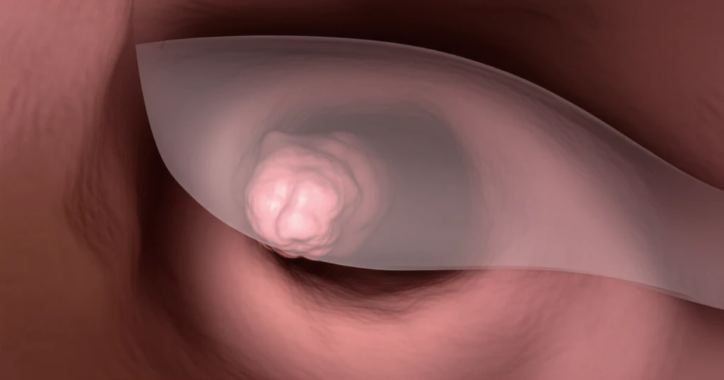 Hidden tumor revealed during a colonoscopy, underscoring the importance of vigilant screening.