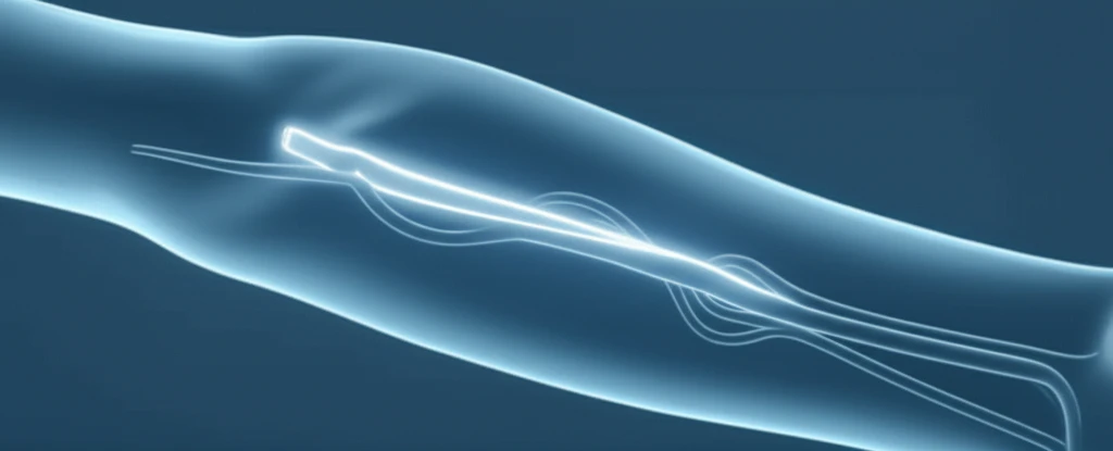 Ultrasound guided angioplasty of arteriovenous fistulas