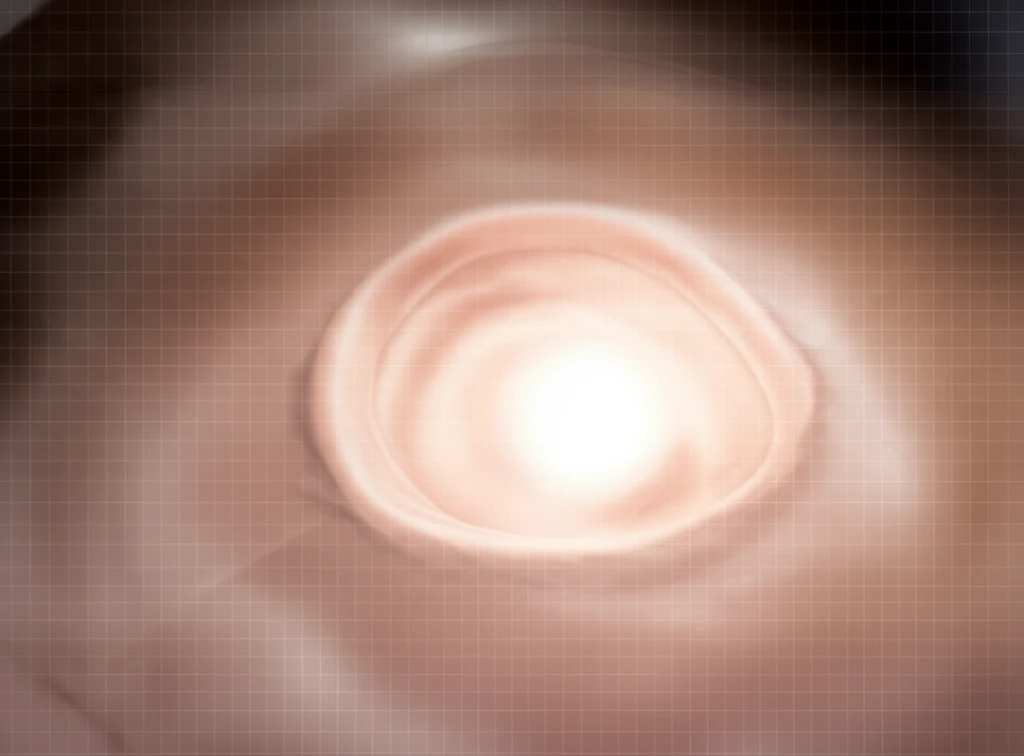 Illustration of healthy peristomal skin with grid overlay representing the PLS assessment scale.