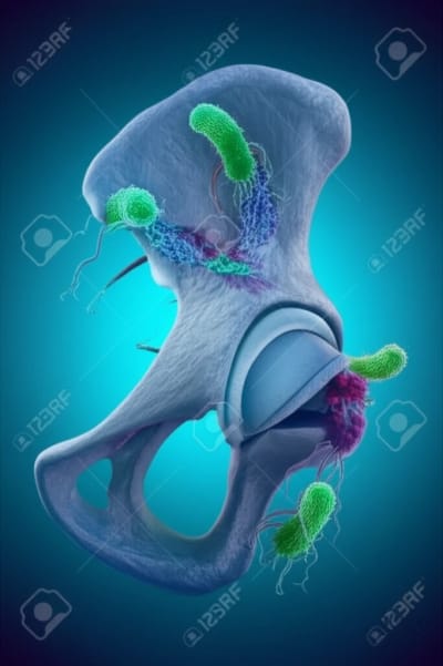 Surreal illustration of sacroiliac joint affected by bacterial infection.