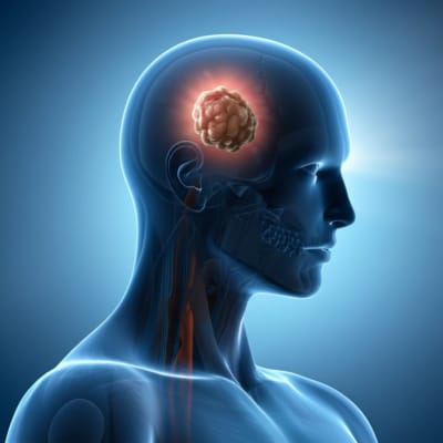 Illustration of melanoma tumor growth with contrasting light symbolizing early detection.