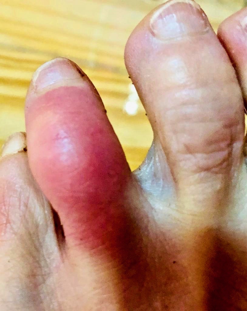 a horrifically swollen toe