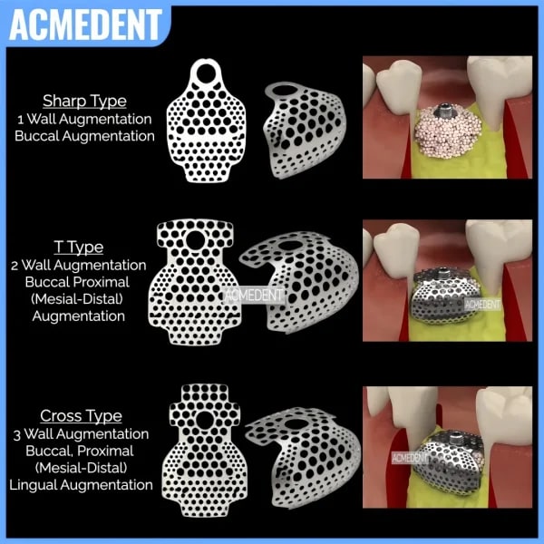 Placa de membrana de regeneración ósea guiada, malla de titanio 3D Dental OB2 GBR, implante, formación ósea, SmartBuilder Incremental, 5 uds.