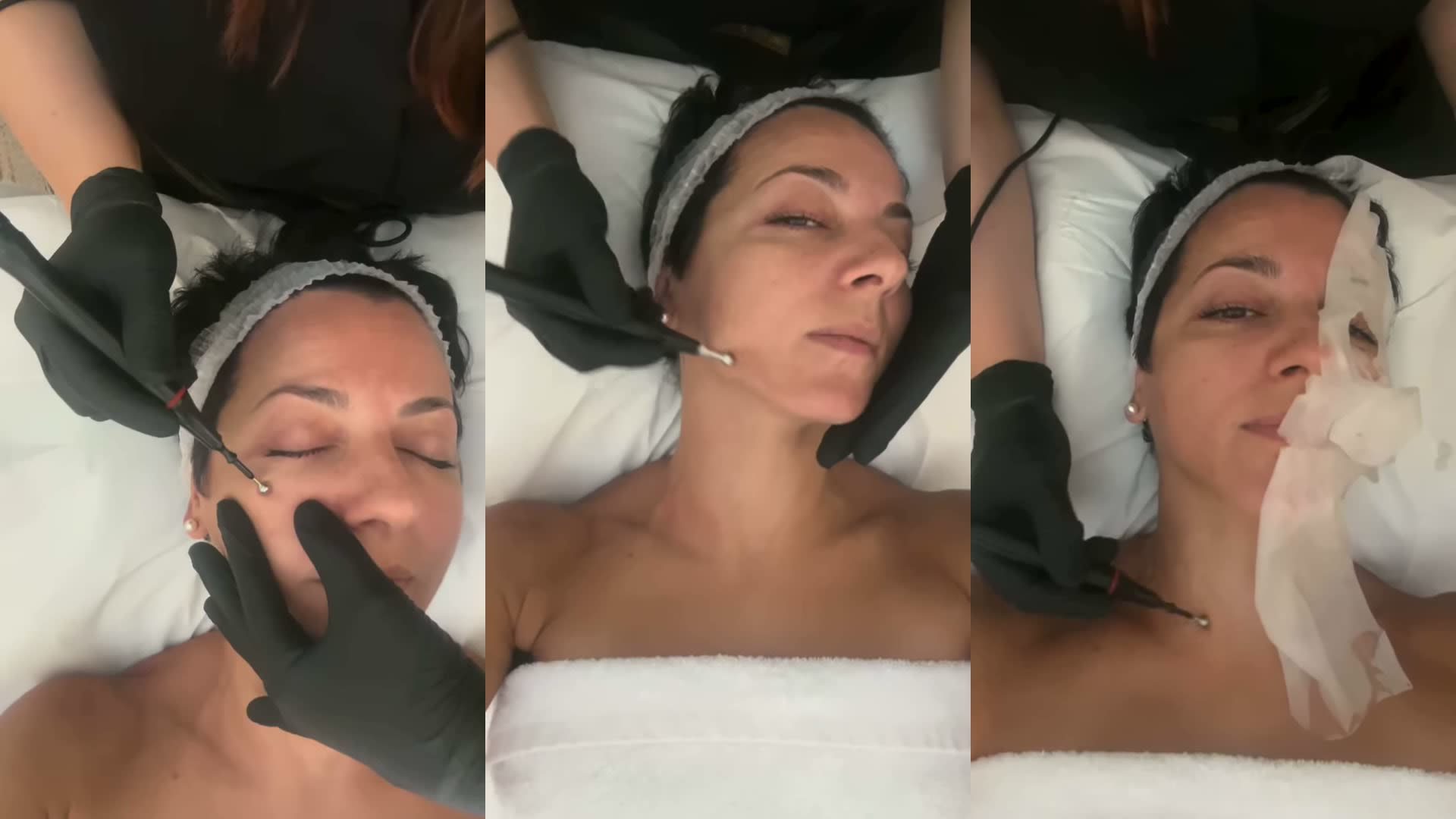 Tre momenti del MICROLIFTING su Valentina: Teslamed sul contorno occhi, sulla mandibola e sul collo con la maschera
