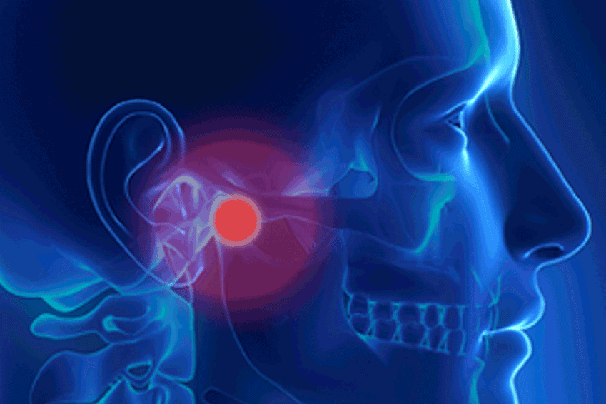 Craniofacial Pain