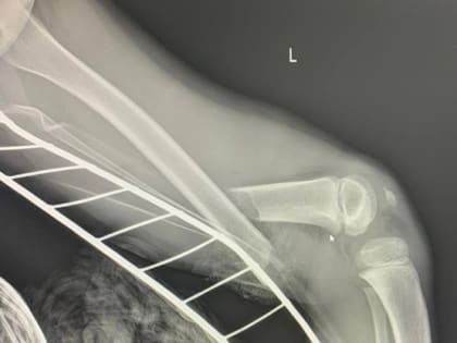 Врачи спасли мальчика из Федоровского от ампутации после падения с качели