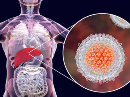 Вирусные гепатиты и как их избежать