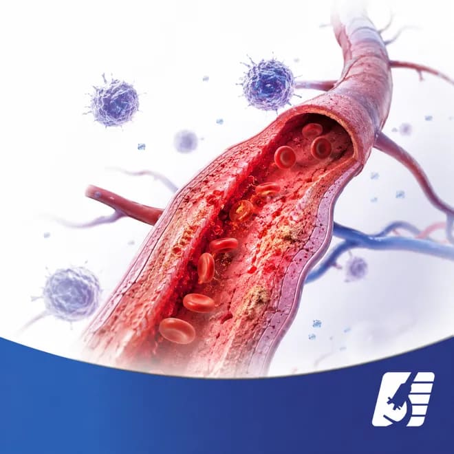vasculitis