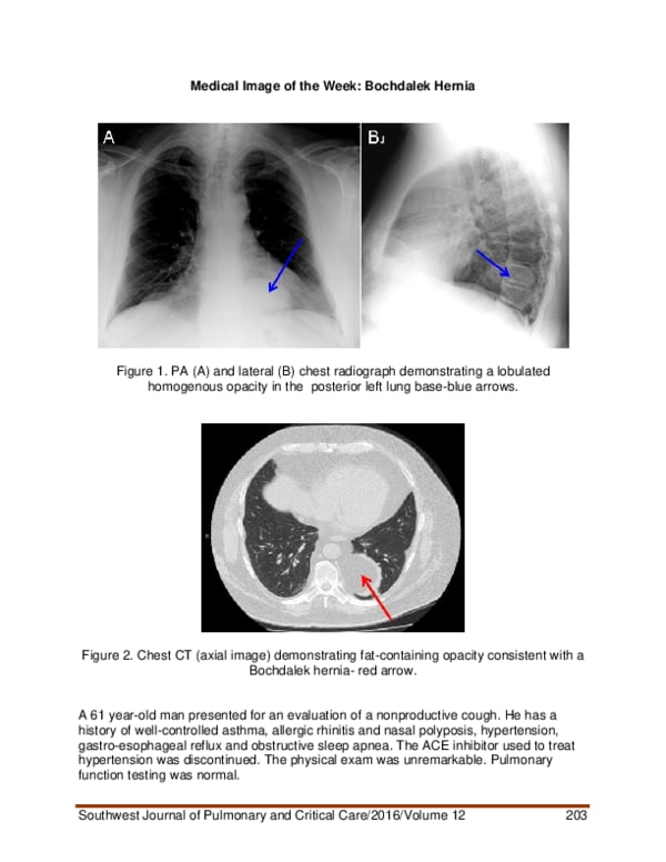 (PDF) Medical image of the week: Bochdalek hernia