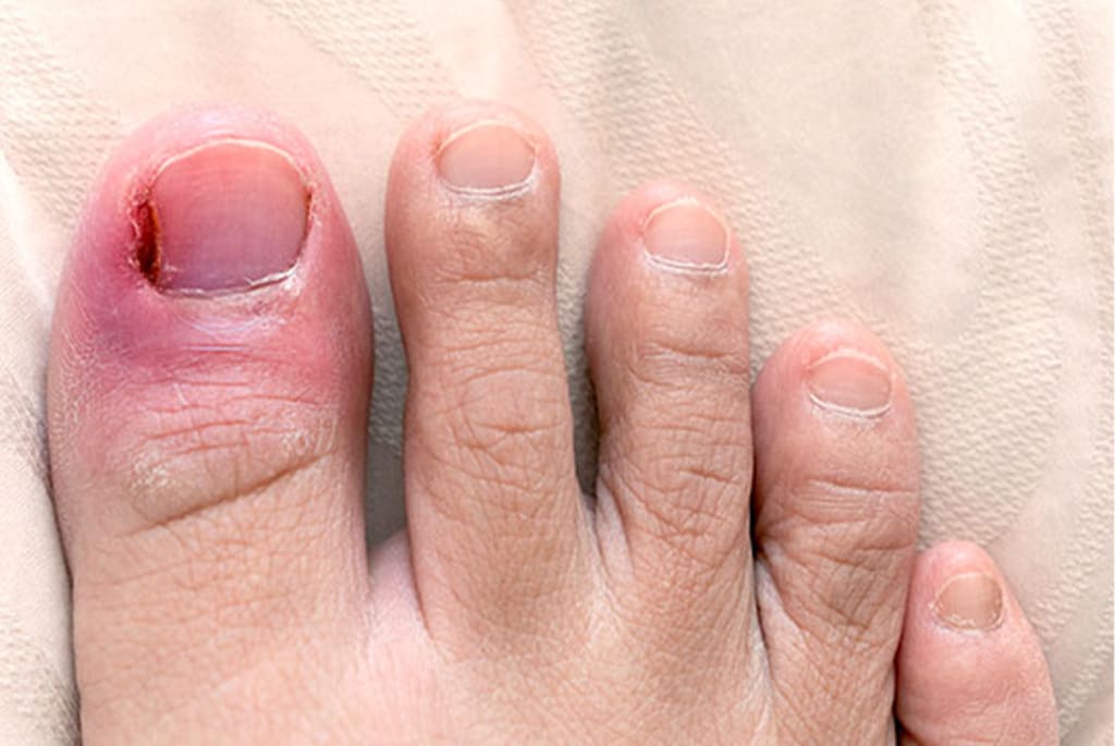 Ingrown Toenails: Signs, Causes, Treatment Prevention, 58% OFF