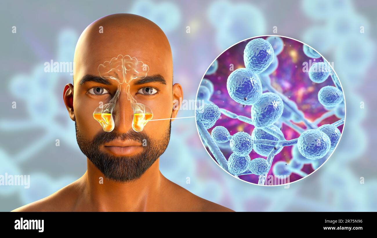 Candida yeast fungi as a cause of sinusitis. Computer illustration ...