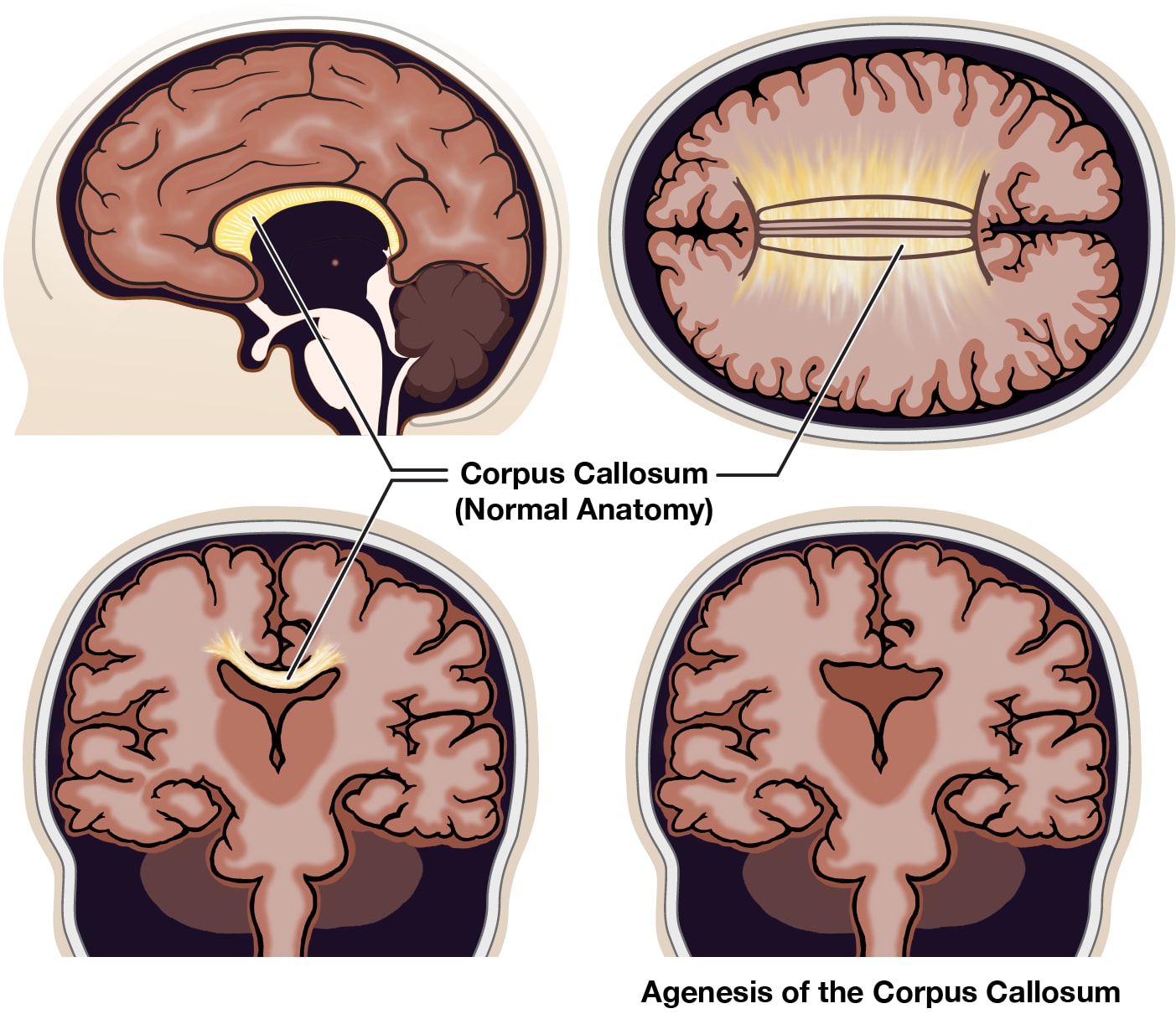 Agenesis of the Corpus Callosum