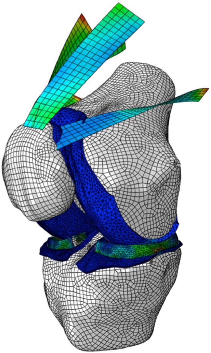 Lateral release associated with MPFL reconstruction in patients with ...