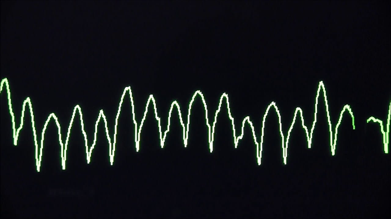 Cardiac arrest rhythms, VF, VT, Asystole and PEA | ข่าวสารล่าสุด ...