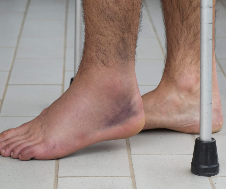 “Just Walk it Off” – and Other Bad Advice Friends Give You About Ankle ...