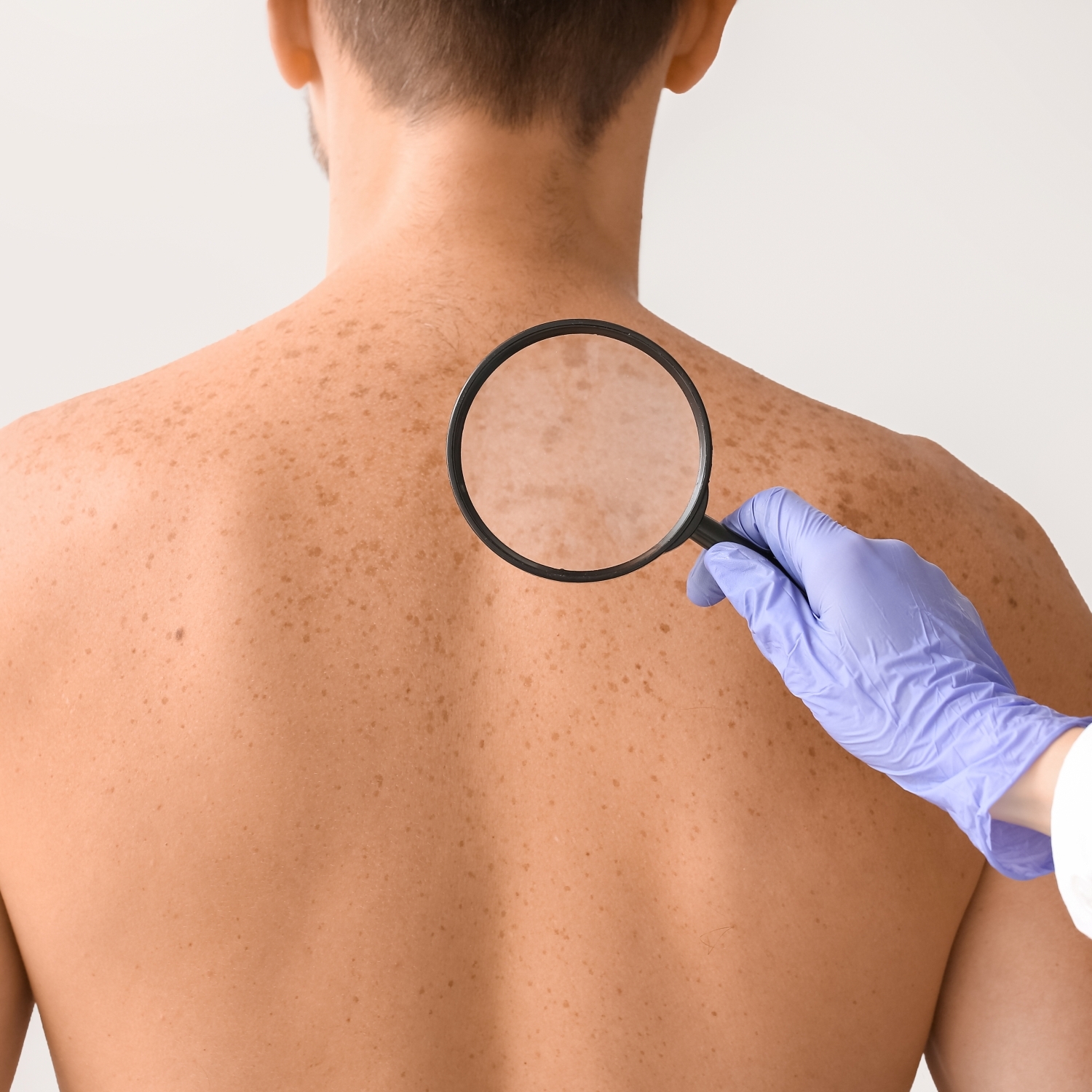 Cover Image for Signs Of Skin Cancer You Should be Looking For