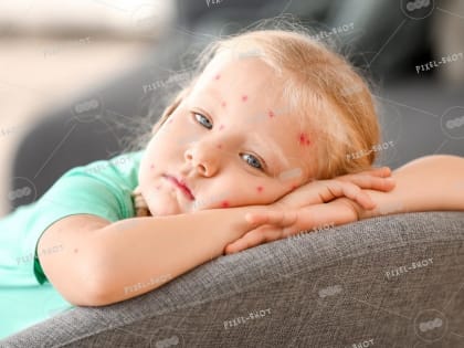 Чтобы избежать заражения ветрянкой и корью, необходимо своевременно прививаться