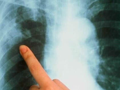 Туберкулёз в Дагестане: эпидемиологическая ситуация и необходимость нового диспансера