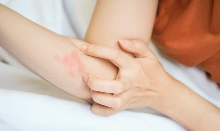 Urticaria (hives)