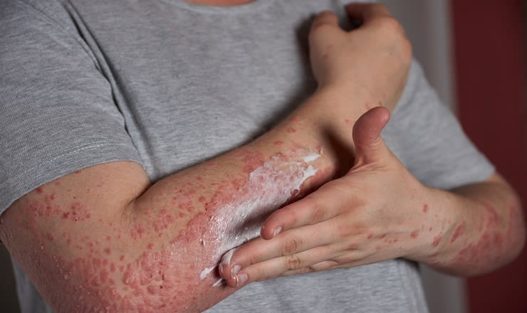 Is That Rash Psoriasis? Psoriasis Pictures and More