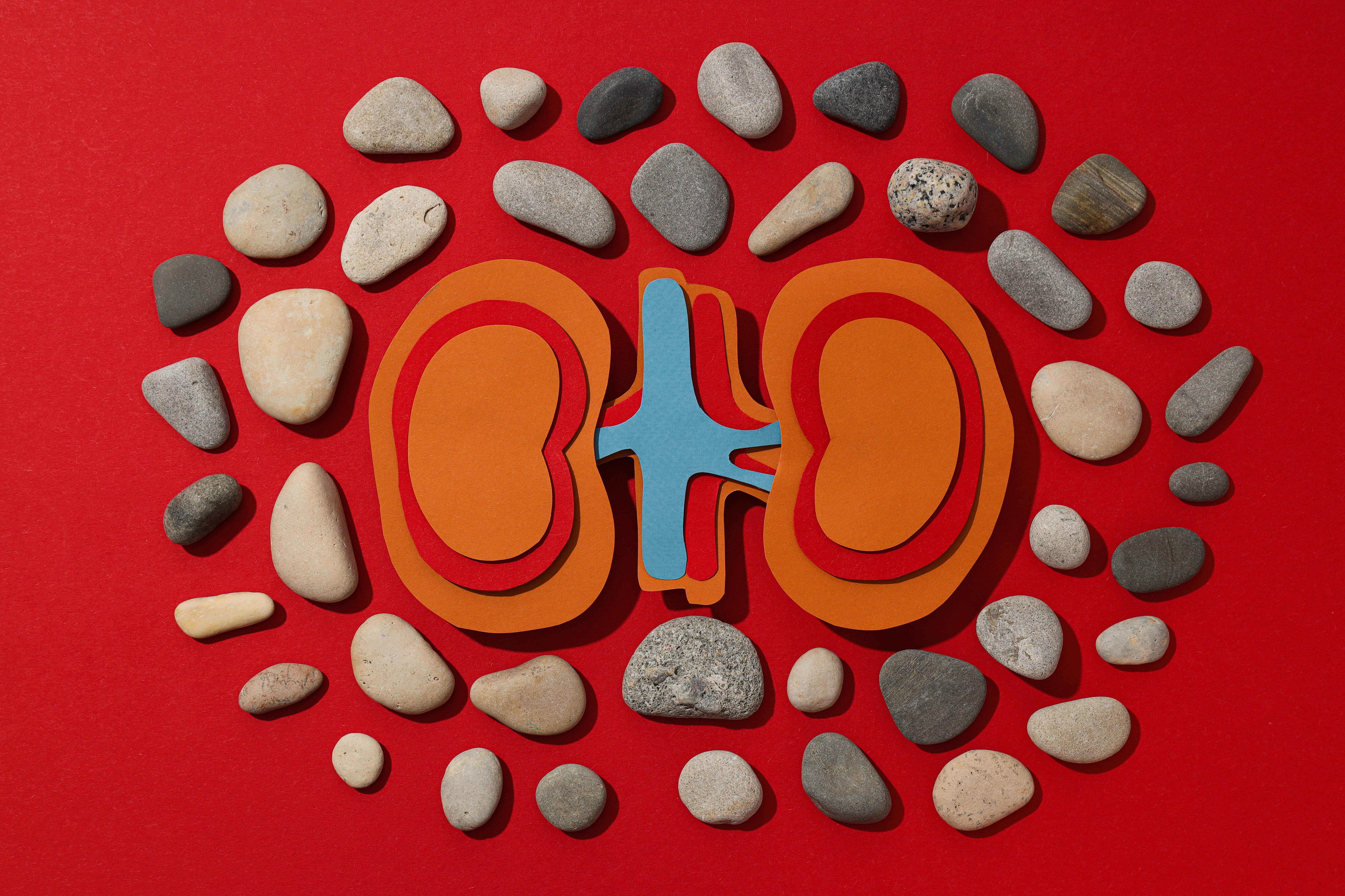 Bacterial Biofilms Found to Play Hidden Role in Kidney Stone Formation