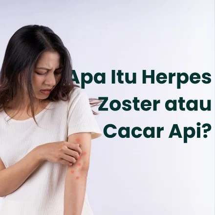 Cacar Api Cacar Api: Penyebab, Gejala, dan Cara Mencegah yang Efektif