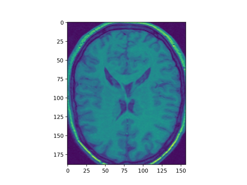 volumetrix example mri