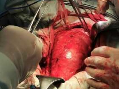 Уфимские медики сделали кесарево сечение женщине с опухолью матки весом 940 грамм