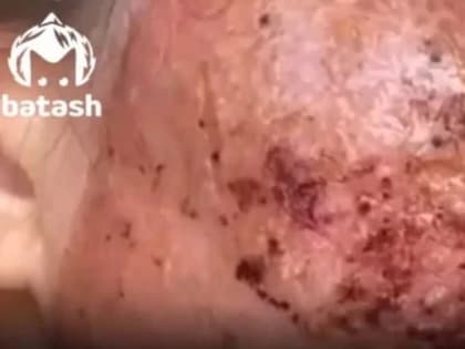 В Башкирии трём клиенткам салона красоты сожгли лица