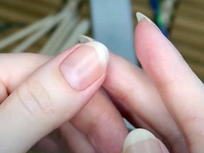 Ученые указали на симптом, который в будущем может обернуться раком — стоит обратить внимание на ногти
