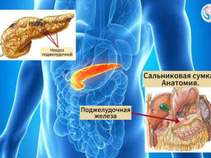 Врачи Больницы на Кутузова спасли пациента с панкреонекрозом