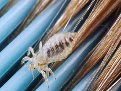 В Красноярском крае на 13% снизилась заболеваемость педикулёзом