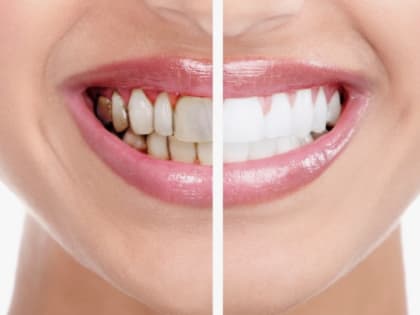 Советы с утра: как возникает зубной камень, чем опасен и как с ним справляться