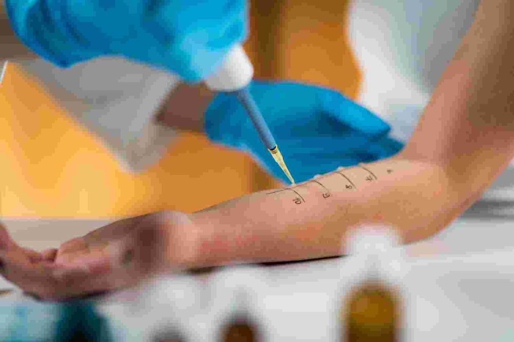 বাংলাদেশে এলার্জি রোগী কেন বাড়ছে? এলার্জি নিয়ন্ত্রণে রাখার কার্যকর উপায়