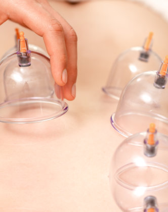 Cupping Therapy
