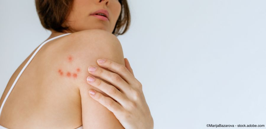 Frau kratzt sich an der Schulter, gebissen von einer Bettwanze