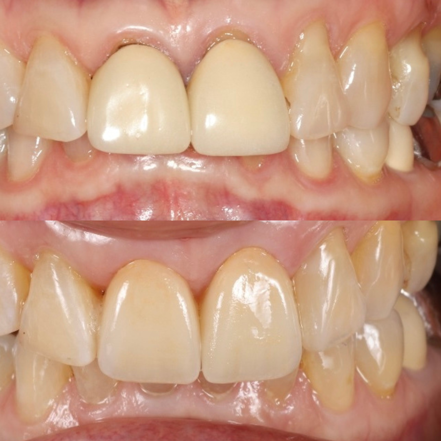 Resolve Tooth Pain & Bleeding Gums