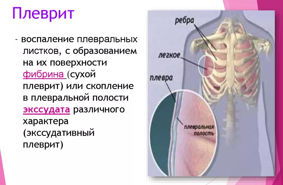Болит правое легкое при вдохе снизу. Что делать если болит правое легкое. Плевральная боль в грудной клетке. Болит в правом легком при вдохе. Болит сердце при глубоком вдохе.