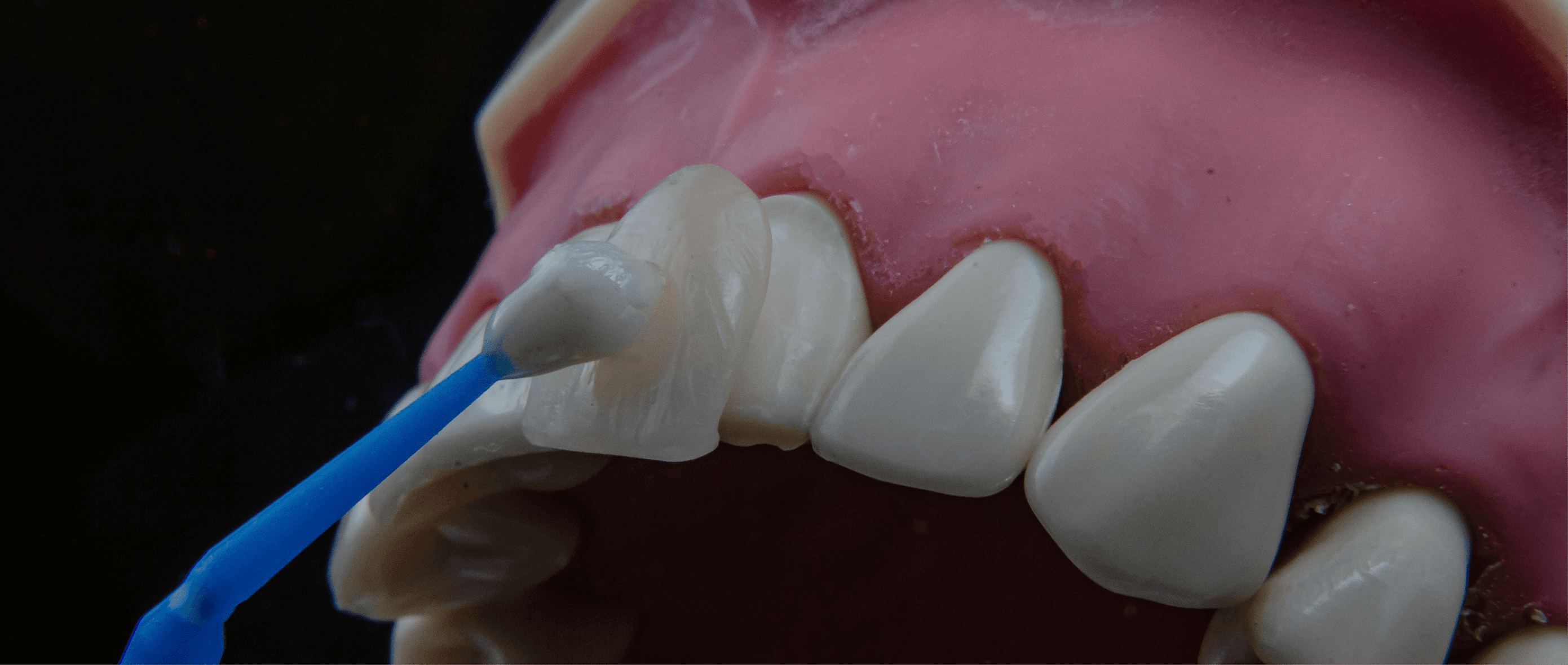 Diş Beyazlatma: Gülüşünüzün Parlaklığını Yeniden Keşfedin