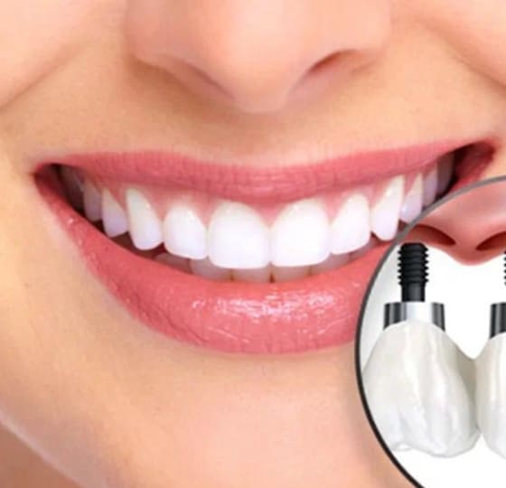 İmplant Tedavisi