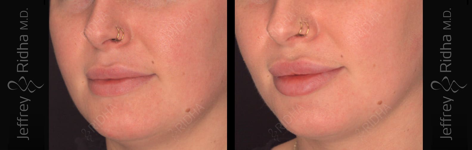 Injectables Before and After - Case 1