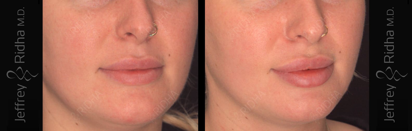 Injectables Before and After - Case 1