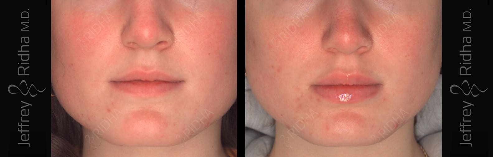 Injectables Before and After - Case 2