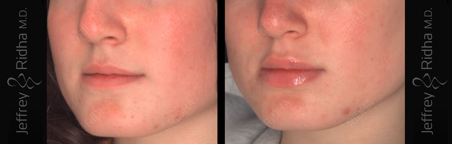 Injectables Before and After - Case 2