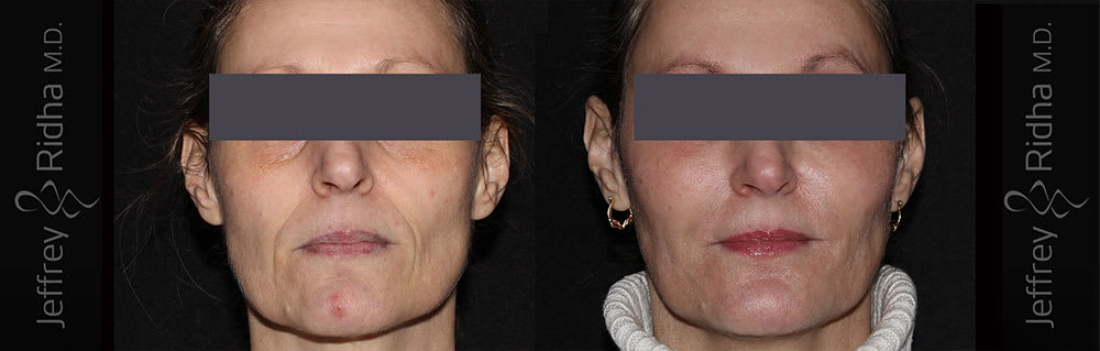 Injectables Before and After - Case 3
