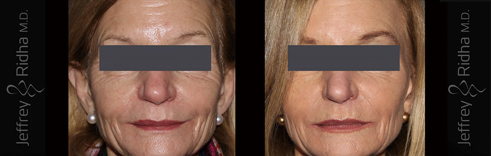 Injectables Before and After - Case 4