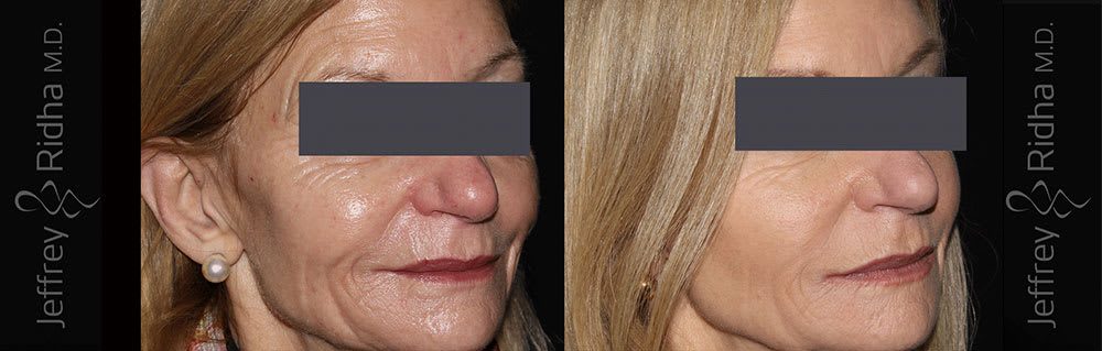 Injectables Before and After - Case 4