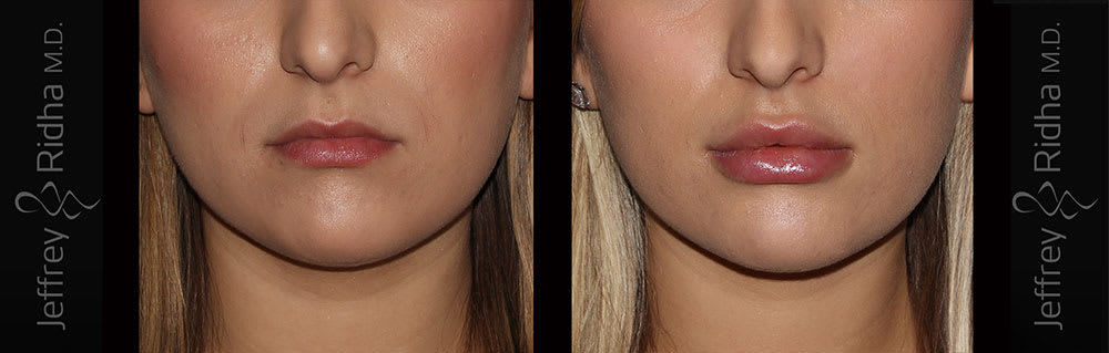 Injectables Before and After - Case 6