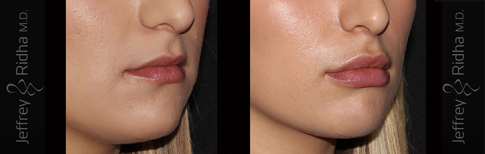 Injectables Before and After - Case 6