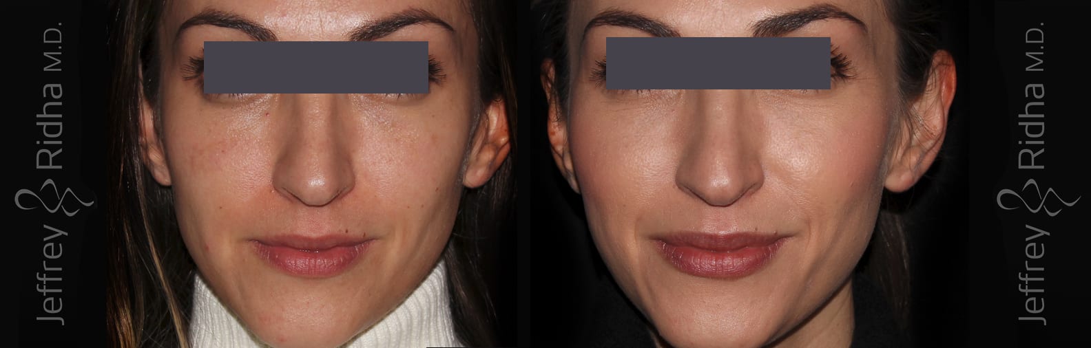 Injectables Before and After - Case 7